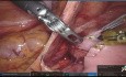 Fully Robotic Duodenojejunostomy for Superior Mesenteric Artery Syndrome