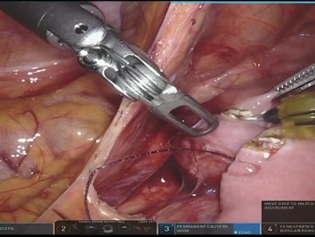 Fully Robotic Duodenojejunostomy for Superior Mesenteric Artery Syndrome
