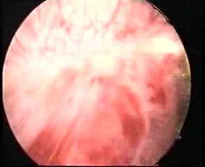 Hysteroscopic Treatment Of Intr Uterine Endometrial Polyp