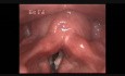 Intracordal Cyst (1)