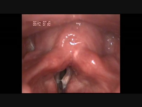 Intracordal Cyst (1)