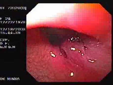 Flexible Endoscopic Suturing - Final Stage of the Procedure