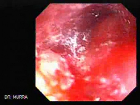 Gastric Cicatrization With Pylorus Stenosis (18 of 23)