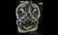 Left Middle Fossa Approach for a Recurrent Cavernous Meningeoma