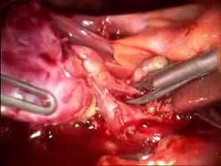 Laparoscopic Treatment Of Cholecystitis