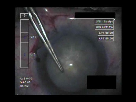 Cataract Surgery IX - Part 1
