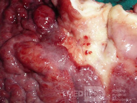 Endoscopy of Scirrhous Gastric Carcinoma involving the entire Fundus, Body and the Antrum (40 of 47)