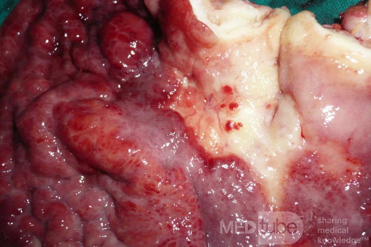 Endoscopy of Scirrhous Gastric Carcinoma involving the entire Fundus, Body and the Antrum (40 of 47)