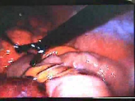 Jejunal Gastrointestinal Stromal tumor (GIST) (19 of 86)