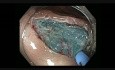 Colonoscopy - Hepatic Flexure Flat Lesion Resection