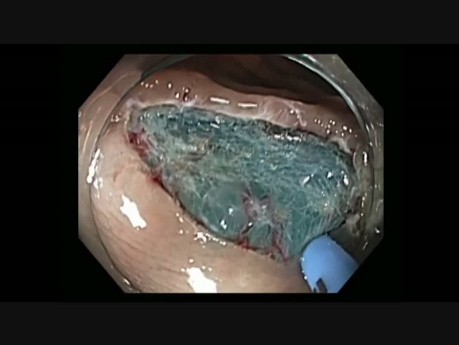 Colonoscopy - Hepatic Flexure Flat Lesion Resection