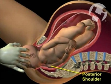 Posterior Shoulder Dystocia with Nerve Root Avulsion