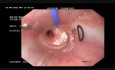 Safe Extraction of an Impacted Open Safety Pin from the Esophagus