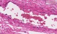Adhesion - Histopathology - Lung, pleura