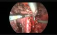 Total Laparoscopic Radical Hysterectomy & Pelvic Lymphadenectomy