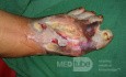 Foot sepsis 