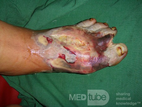 Foot sepsis 