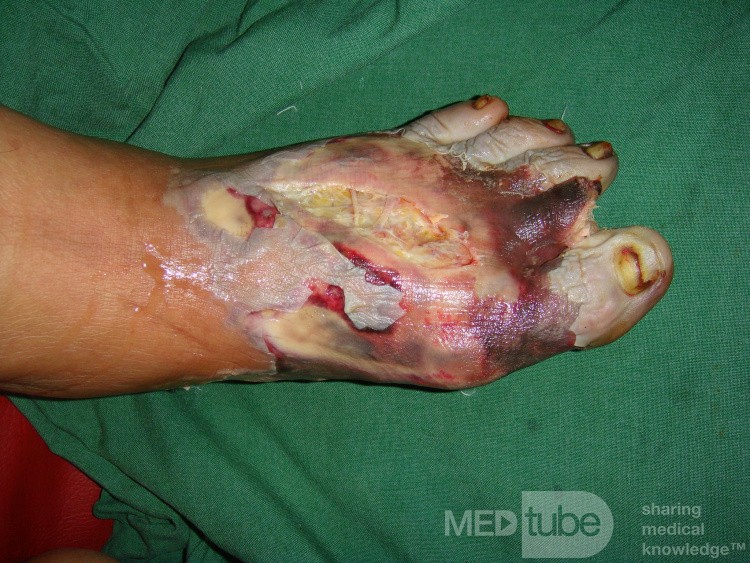 Foot sepsis 
