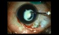 Paediatric Cataract Surgery after Delayed Presentation