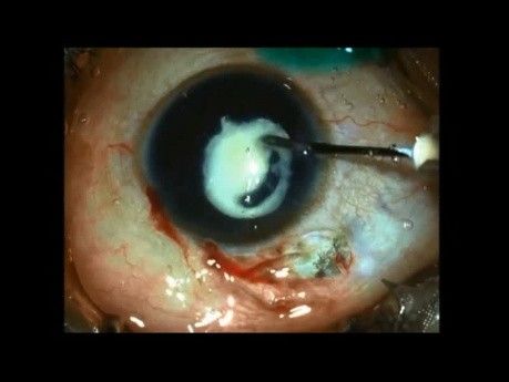 Paediatric Cataract Surgery after Delayed Presentation