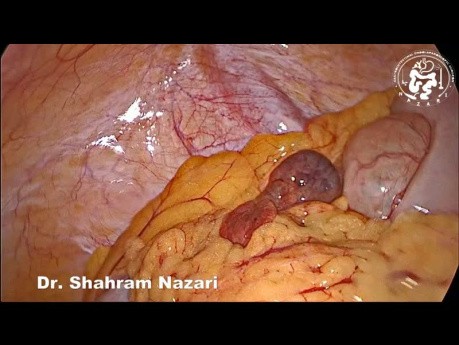Incidentally Found Appendix Epiploica Gangrene