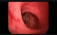 Low Rectal Polyp TAMIS