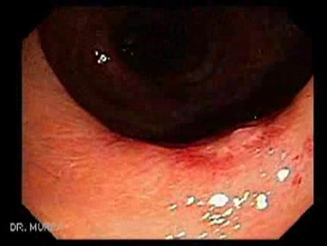 Giant Tubulo - Villous Adenoma (17 of 17)