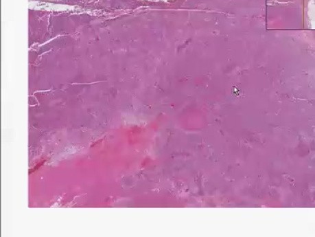 Adrenocortical carcinoma - Histopathology - Adrenal