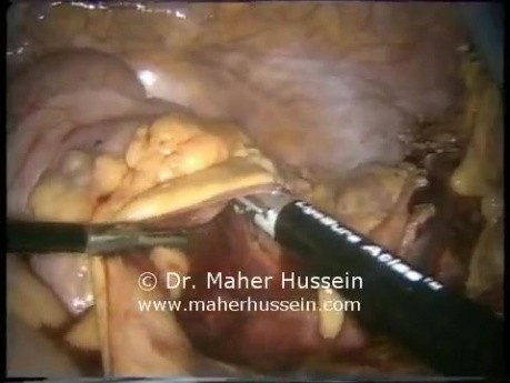 Laparoscopic Right Extended Colectomy