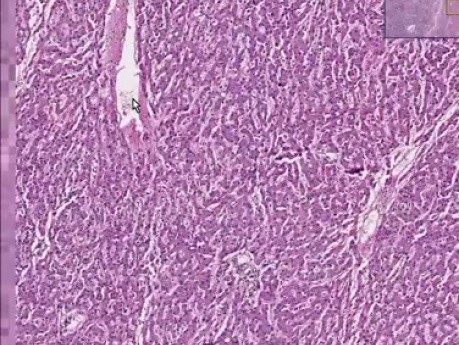 Metastatic adenocarcinoma of stomach - Histopathology - Liver