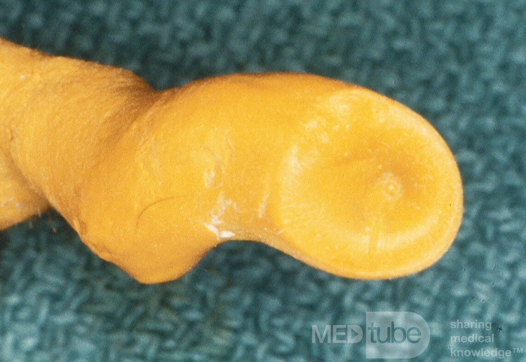 The Oblique Orientation of the Tympanic Membrane