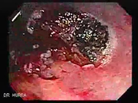 Endoscopic Resection of Giant Tubulo-Villous of the rectum (18 of 35)