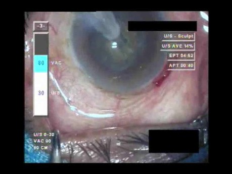 Cataract Surgery IV - Part 2