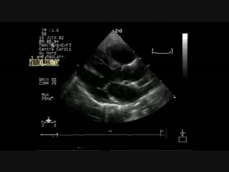 Multiple Cardiac Rhabdomyoma - 2 - Follow Up - Regression