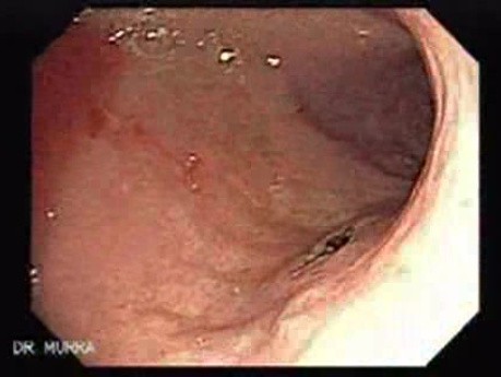 Multiple Gastric Angiodysplasia (14 of 17)