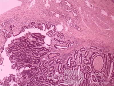 Cholangiocarcinoma that infiltrated a Periampullary Duodenal Diverticula and the head of the pancreas (15 of 20)