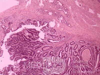 Cholangiocarcinoma that infiltrated a Periampullary Duodenal Diverticula and the head of the pancreas (15 of 20)