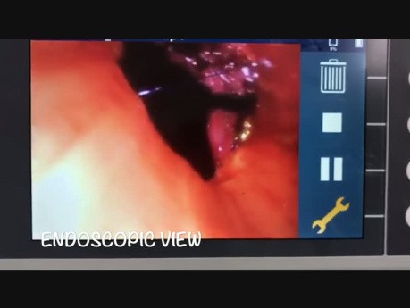 Robotic Thoracic Surgery - Left Main Bronchus Bronchoplasty