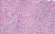 Squamous cell carcinoma - Histopathology of penis