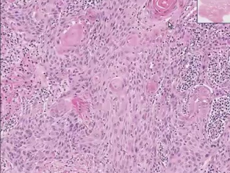 Squamous cell carcinoma - Histopathology of penis