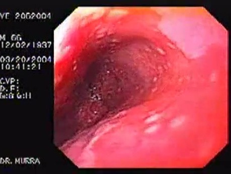 Barrett's Esophagus of long segment (2 of 24)