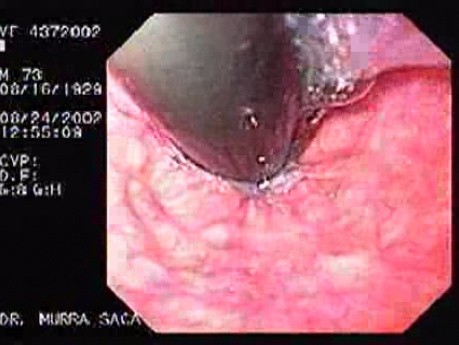 Superior Esophagic Sphincter - retroflexed view (1 of 2)