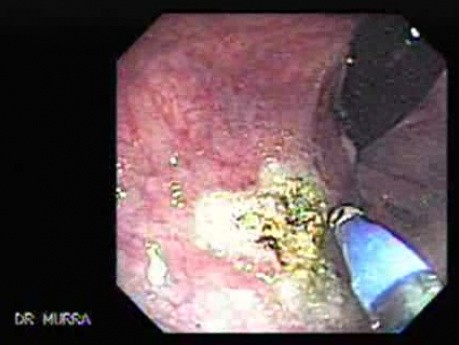 Rectal Dieulafoy’s Lesion (3 of 4)
