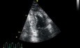 Atrial Fibrilation In Cardiac Echo