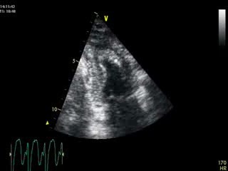 Atrial Fibrilation In Cardiac Echo