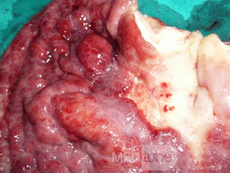 Endoscopy of Scirrhous Gastric Carcinoma involving the entire Fundus, Body and the Antrum (41 of 47)