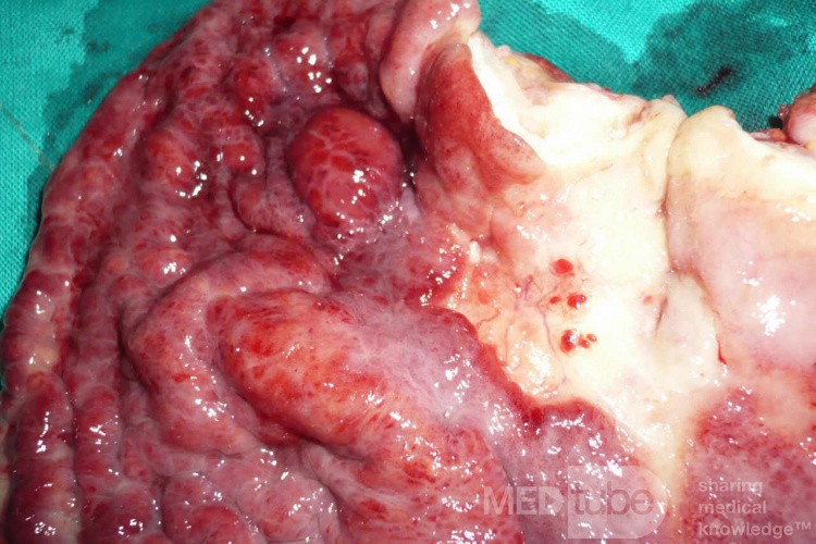 Endoscopy of Scirrhous Gastric Carcinoma involving the entire Fundus, Body and the Antrum (41 of 47)