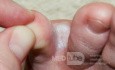 Interdigital Tinea pedis