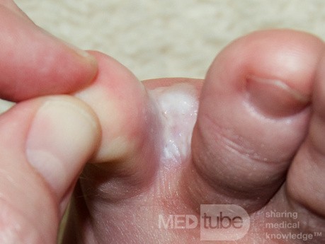 Interdigital Tinea pedis