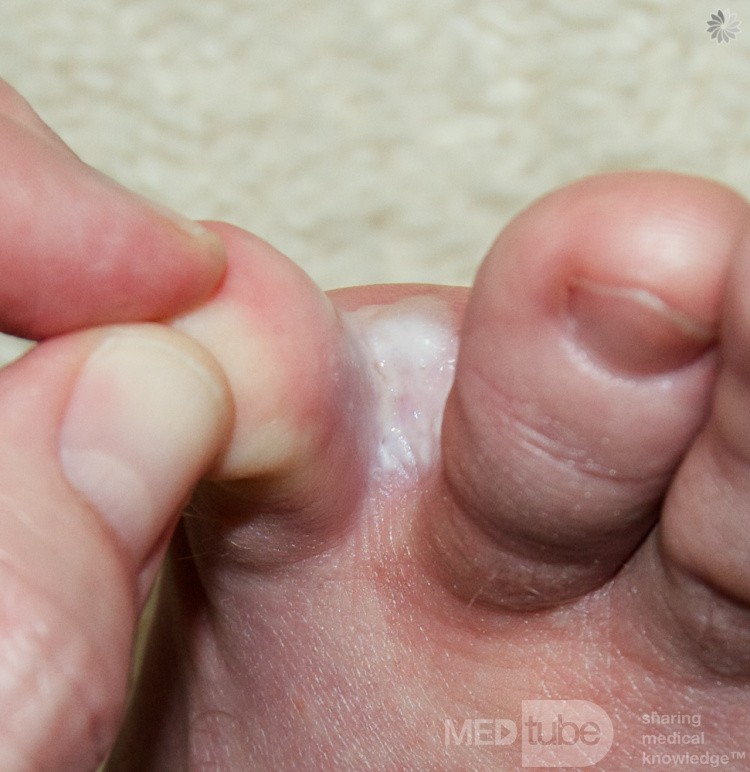 Interdigital Tinea pedis